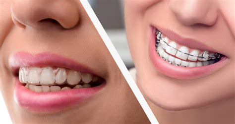 ceramic clear brackets vs metal brackets for braces|clear aligners vs braces.